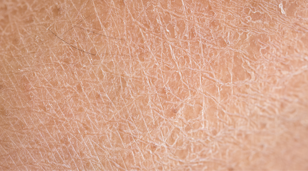 What's Making Your Skin So Dry?
